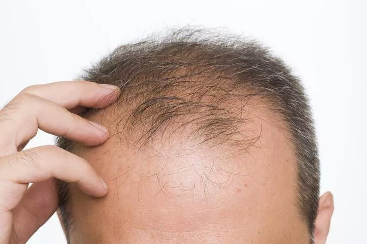 Kel erkekler en çok bu ülkede! Yapılan son araştırma herkesi şaşırttı: Saçları çok süratli dökülüyor